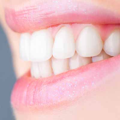 Faccette Dentali